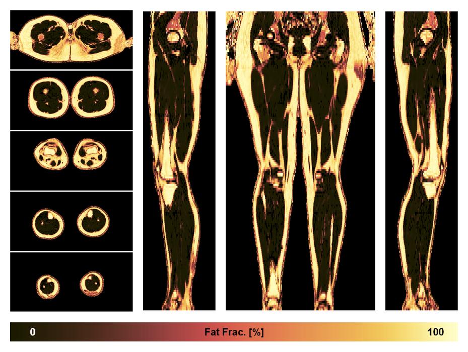 The fat fraction of the lower extremity obtained from the dixon reconstruction for muscle water fat quantification.